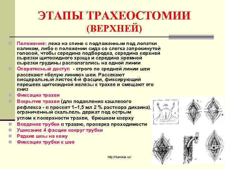 ЭТАПЫ ТРАХЕОСТОМИИ (ВЕРХНЕЙ) n n n n Положение: лежа на спине с подложенным под