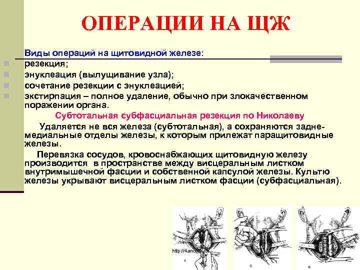 ОПЕРАЦИИ НА ЩЖ n n Виды операций на щитовидной железе: резекция; энуклеация (вылущивание узла);