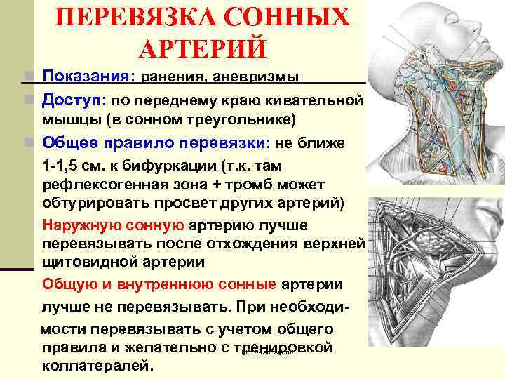 ПЕРЕВЯЗКА СОННЫХ АРТЕРИЙ n Показания: ранения, аневризмы n Доступ: по переднему краю кивательной мышцы