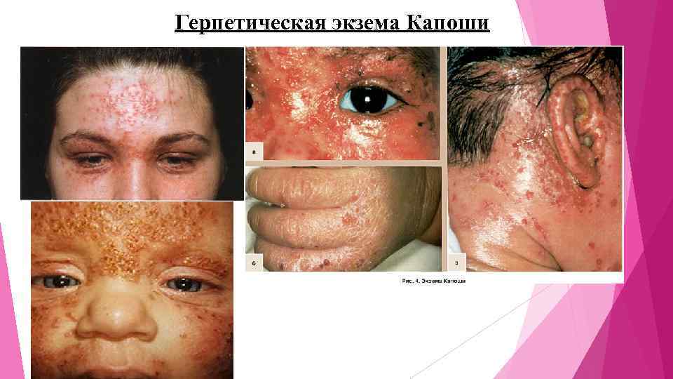 Герпетическая экзема Капоши 
