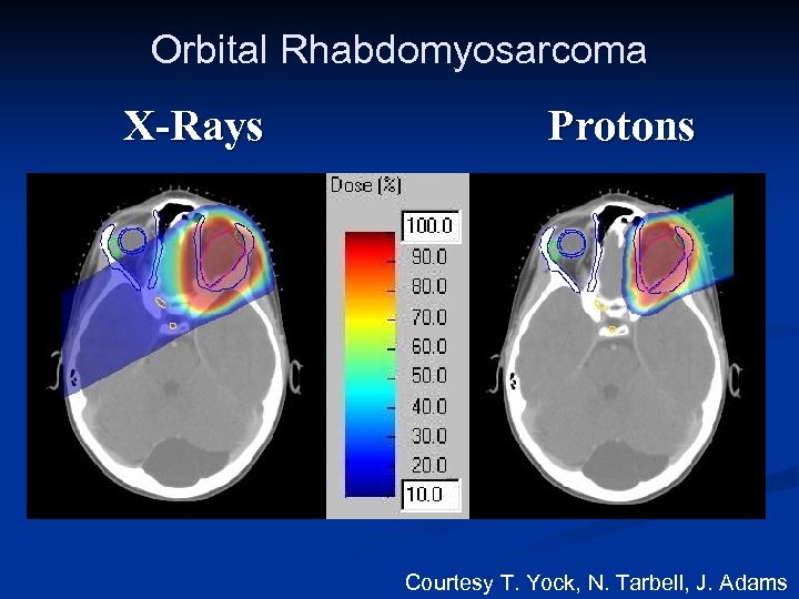 Orbital Rhabdomyosarcoma X-Rays Protons Courtesy T. Yock, N. Tarbell, J. Adams 