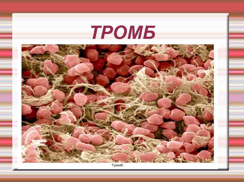 ТРОМБ 
