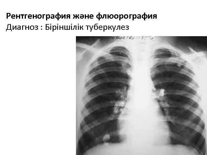Рентгенография және флюорография Диагноз : Біріншілік туберкулез 