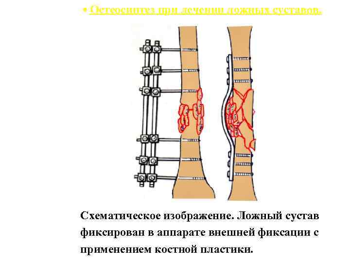 Барнаул суставы операция. Классификация ложных суставов. Возникновение ложного сустава. Остеосинтез при псевдоартрозе.