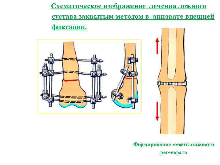 Ложный сустав рисунок