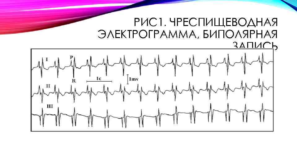 РИС 1. ЧРЕСПИЩЕВОДНАЯ ЭЛЕКТРОГРАММА, БИПОЛЯРНАЯ ЗАПИСЬ 