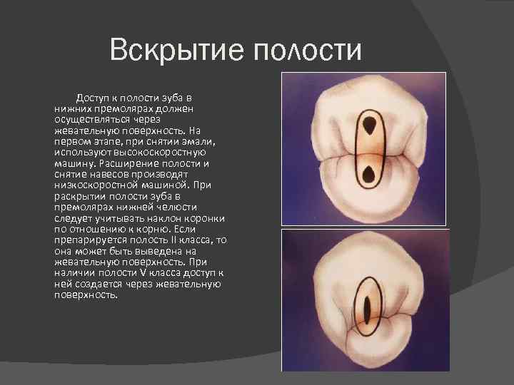 Вскрытие полости Доступ к полости зуба в нижних премолярах должен осуществляться через жевательную поверхность.