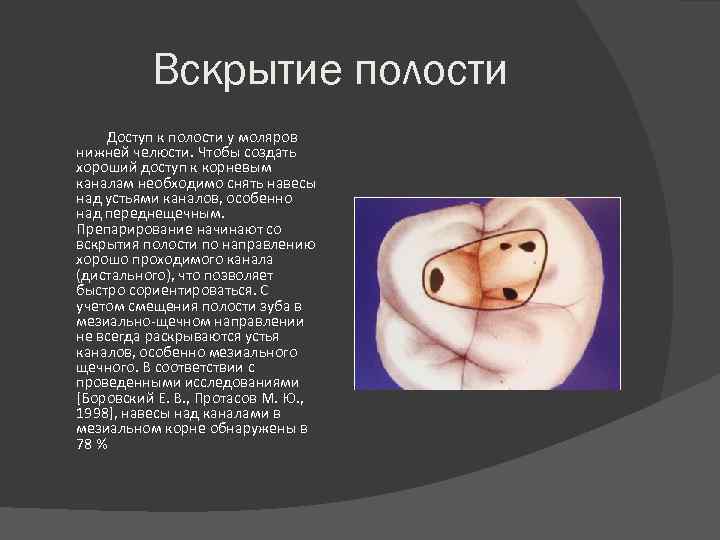 Вскрытие полости Доступ к полости у моляров нижней челюсти. Чтобы создать хороший доступ к