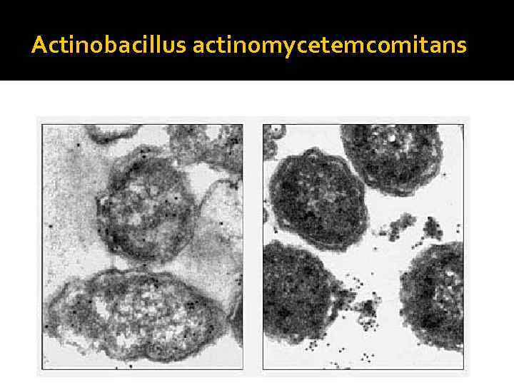 Actinobacillus actinomycetemcomitans 