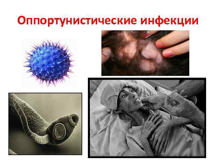 Оппортунистические инфекции 