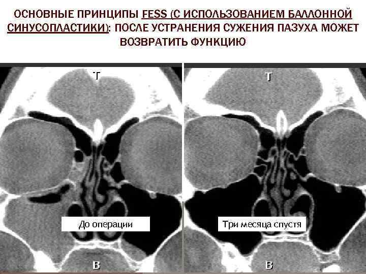 ОСНОВНЫЕ ПРИНЦИПЫ FESS (С ИСПОЛЬЗОВАНИЕМ БАЛЛОННОЙ СИНУСОПЛАСТИКИ): ПОСЛЕ УСТРАНЕНИЯ СУЖЕНИЯ ПАЗУХА МОЖЕТ ВОЗВРАТИТЬ ФУНКЦИЮ