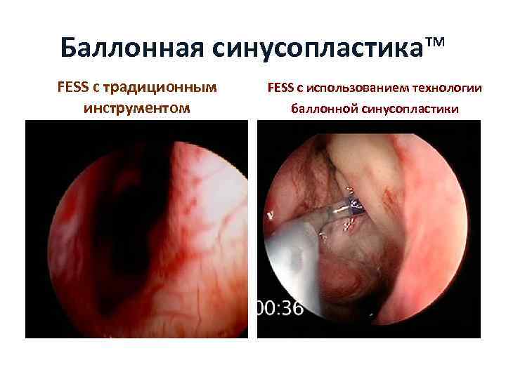 Баллонная синусопластика™ FESS с традиционным инструментом FESS с использованием технологии баллонной синусопластики 