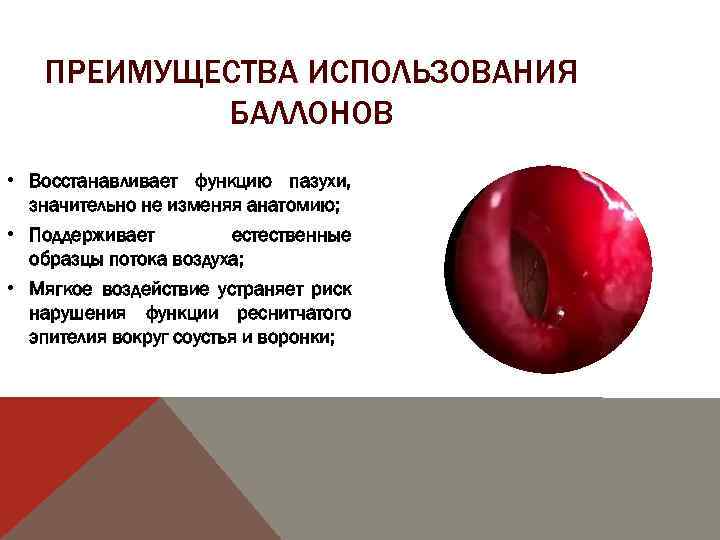 ПРЕИМУЩЕСТВА ИСПОЛЬЗОВАНИЯ БАЛЛОНОВ • Восстанавливает функцию пазухи, значительно не изменяя анатомию; • Поддерживает естественные