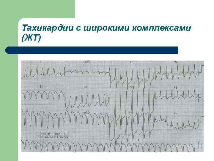 Тахикардии с широкими комплексами (ЖТ) 