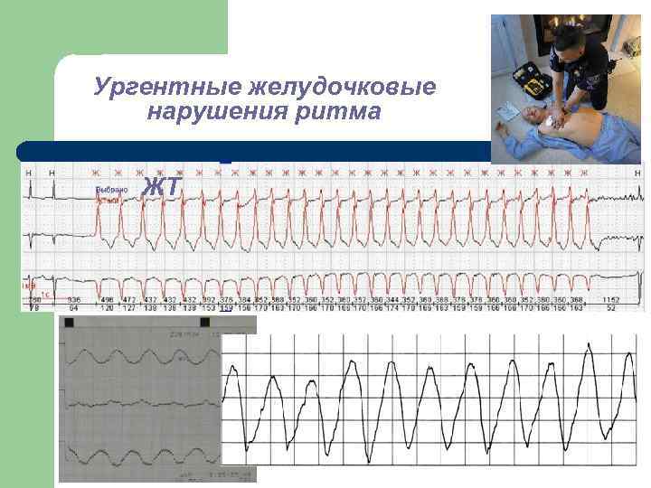 Ургентные желудочковые нарушения ритма ЖТ 