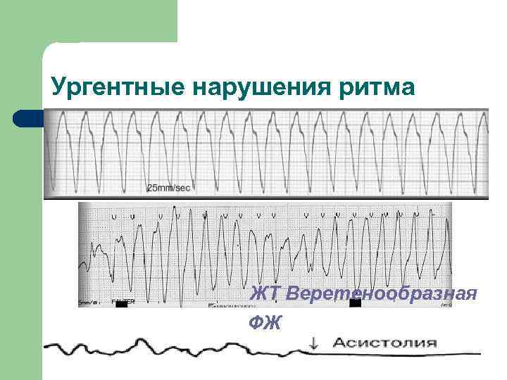 Ургентные нарушения ритма ЖТ Веретенообразная ФЖ 