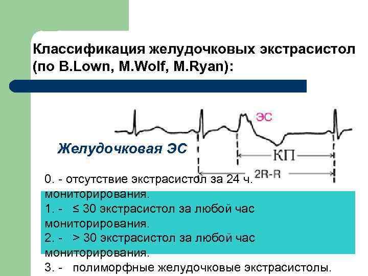 Классификация желудочковых экстрасистол (по B. Lown, M. Wolf, M. Ryan): Желудочковая ЭС 0. -