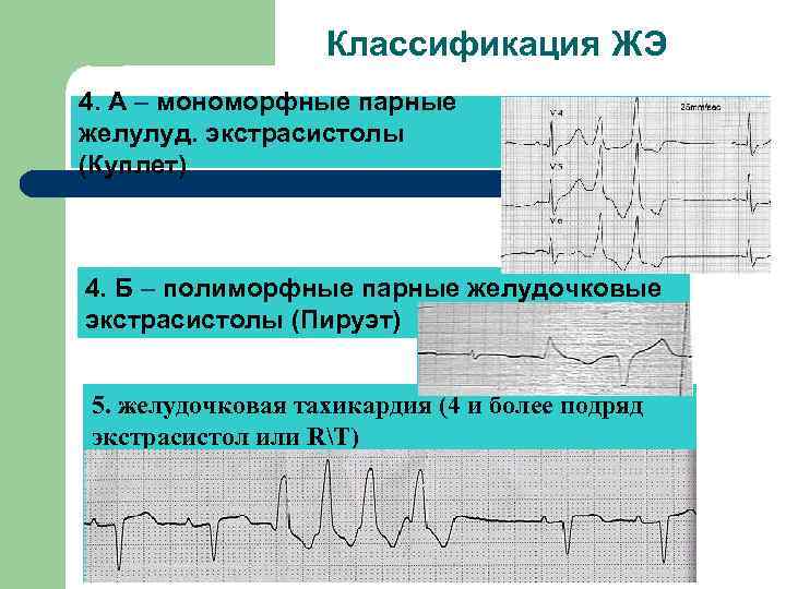 Классификация ЖЭ 4. А – мономорфные парные желулуд. экстрасистолы (Куплет) 4. Б – полиморфные