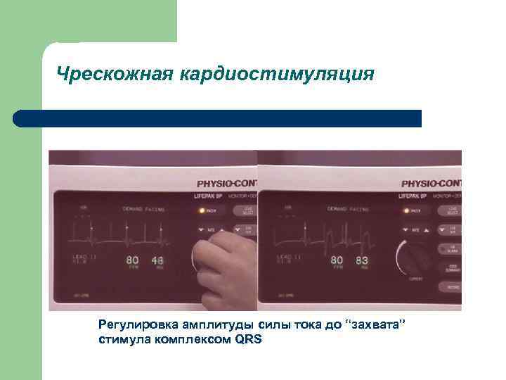 Чрескожная кардиостимуляция Регулировка амплитуды силы тока до “захвата” стимула комплексом QRS 