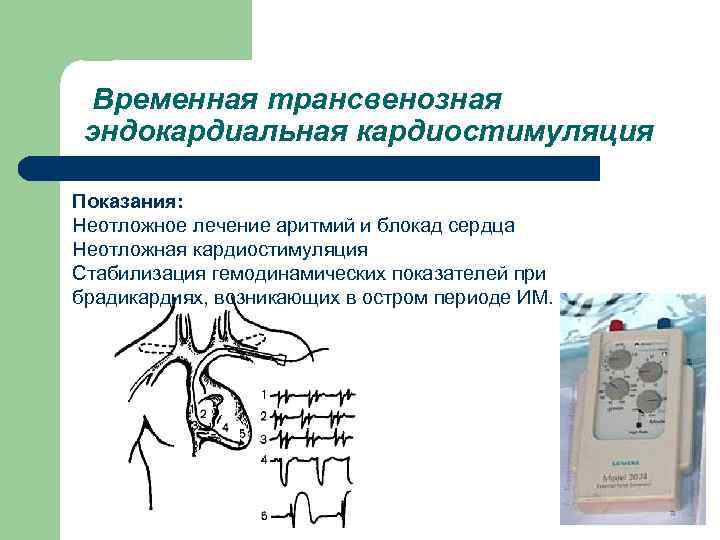  Временная трансвенозная эндокардиальная кардиостимуляция Показания: Неотложное лечение аритмий и блокад сердца Неотложная кардиостимуляция