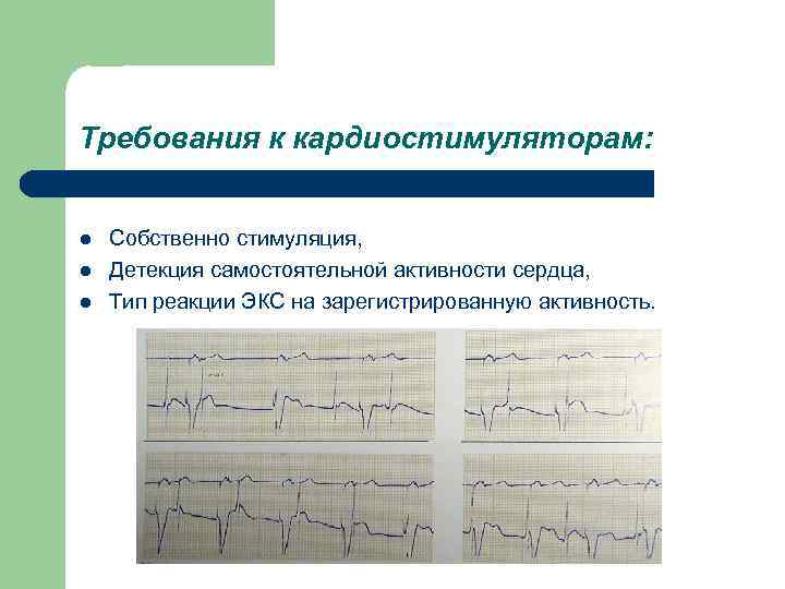 Требования к кардиостимуляторам: l l l Собственно стимуляция, Детекция самостоятельной активности сердца, Тип реакции