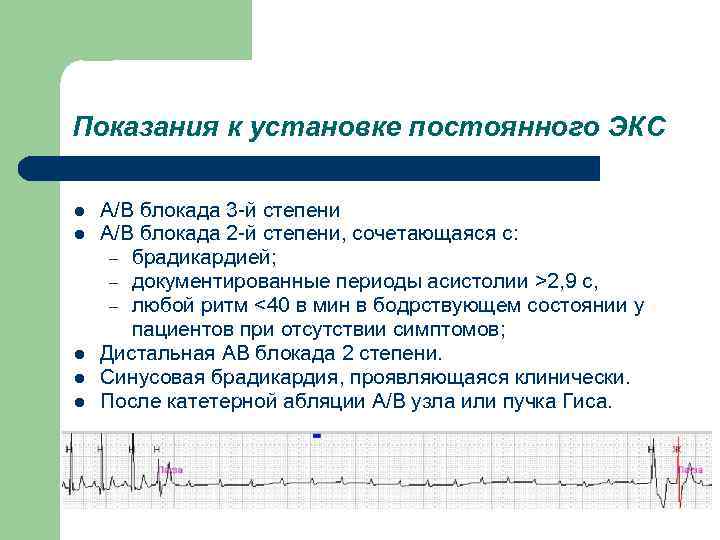 Показания к установке постоянного ЭКС l l l А/В блокада 3 -й степени А/В