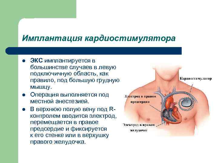 Имплантация кардиостимулятора l l l ЭКС имплантируется в большинстве случаев в левую подключичную область,