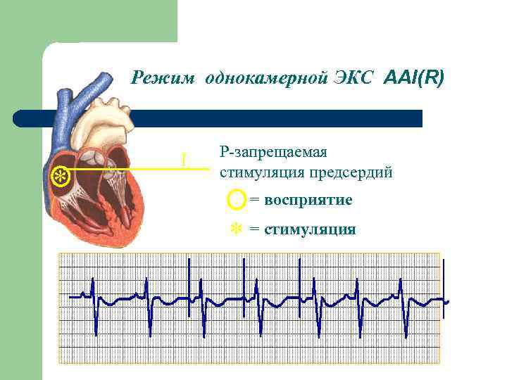 Режим однокамерной ЭКС ААI(R) * I Р-запрещаемая стимуляция предсердий AAI(R) = восприятие * =