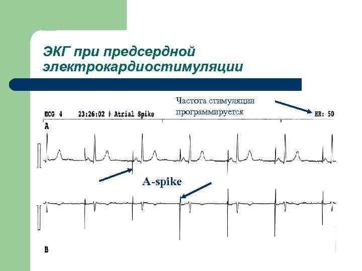 Экг с кардиостимулятором картинки