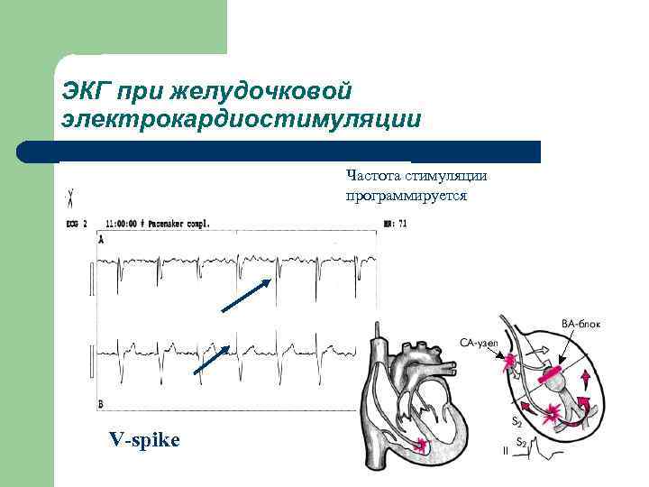 ЭКГ при желудочковой электрокардиостимуляции Частота стимуляции программируется V-spike 
