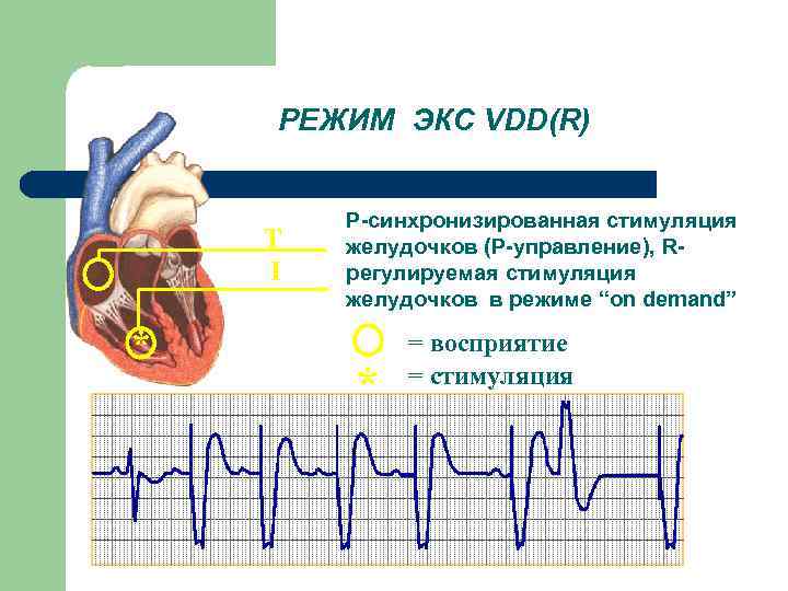 РЕЖИМ ЭКС VDD(R) T I * Р-синхронизированная стимуляция желудочков (Р-управление), Rрегулируемая стимуляция желудочков в