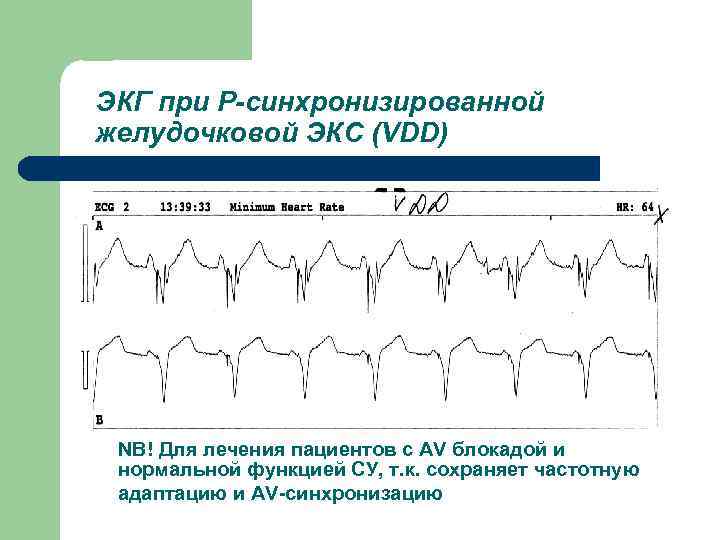 ЭКГ при Р-синхронизированной желудочковой ЭКС (VDD) NB! Для лечения пациентов с AV блокадой и