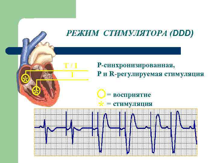 РЕЖИМ СТИМУЛЯТОРА (DDD) * T/I I * Р-синхронизированная, Р и R-регулируемая стимуляция DDD(R) *