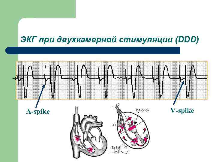 ЭКГ при двухкамерной стимуляции (DDD) A-spike V-spike 