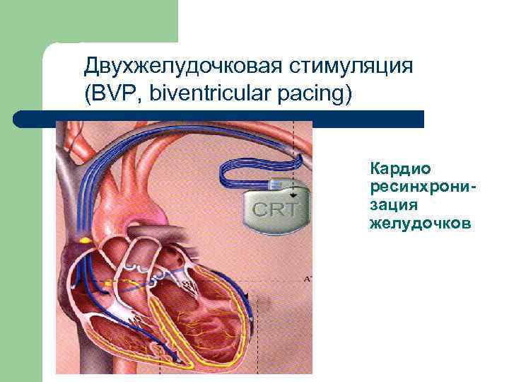 Двухжелудочковая стимуляция (BVP, biventricular pacing) Кардио ресинхронизация желудочков 