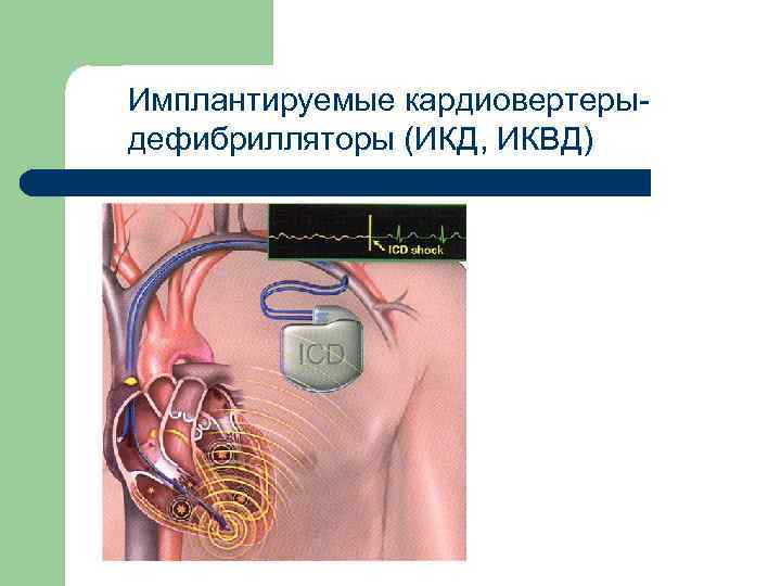 Имплантируемые кардиовертерыдефибрилляторы (ИКД, ИКВД) 