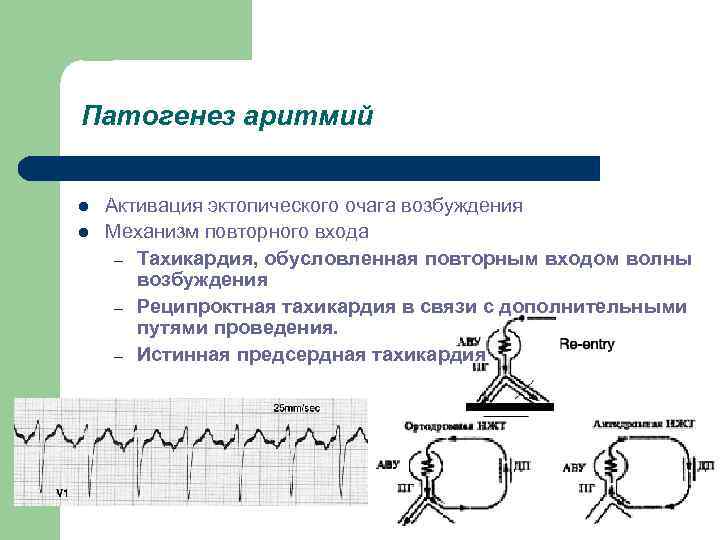 Патогенез аритмий l l Активация эктопического очага возбуждения Механизм повторного входа – Тахикардия, обусловленная