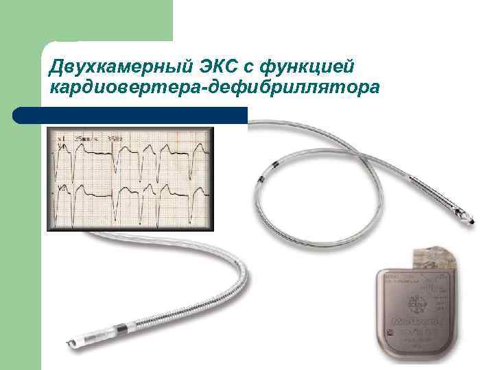 Двухкамерный ЭКС с функцией кардиовертера-дефибриллятора 