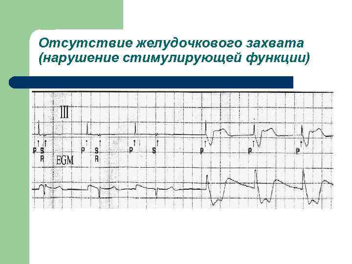 Отсутствие желудочкового захвата (нарушение стимулирующей функции) 