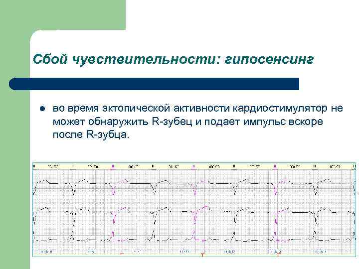 Сбой чувствительности: гипосенсинг l во время эктопической активности кардиостимулятор не может обнаружить R-зубец и