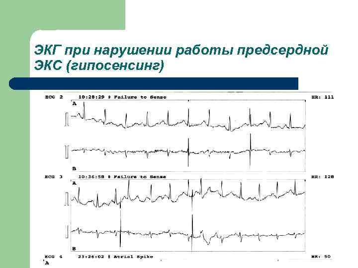 ЭКГ при нарушении работы предсердной ЭКС (гипосенсинг) 