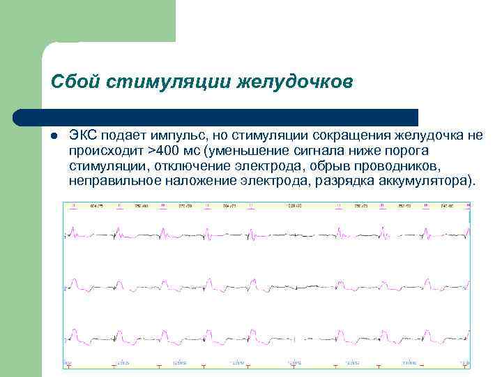 Сбой стимуляции желудочков l ЭКС подает импульс, но стимуляции сокращения желудочка не происходит >400