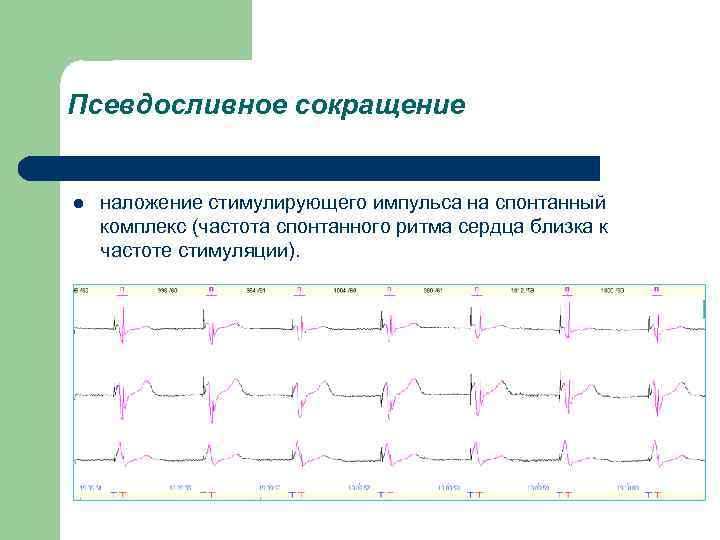 Псевдосливное сокращение l наложение стимулирующего импульса на спонтанный комплекс (частота спонтанного ритма сердца близка