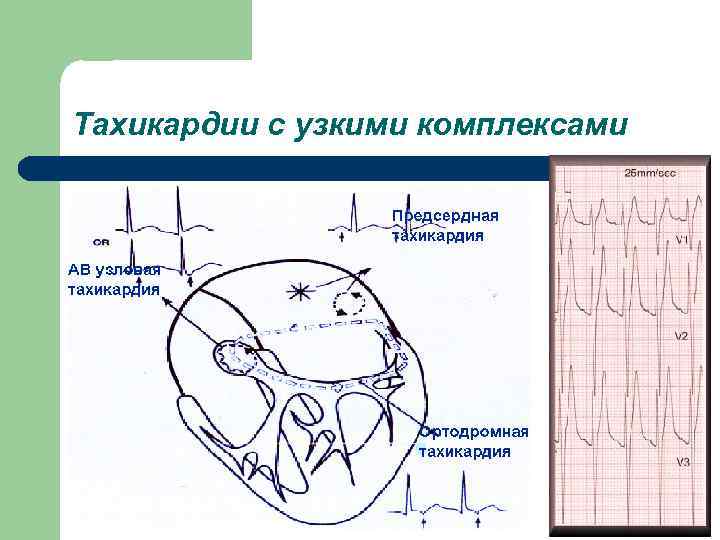 Тахикардии с узкими комплексами 