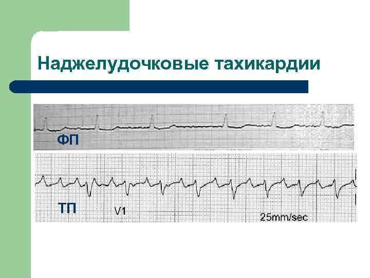 Наджелудочковые тахикардии ФП ТП 