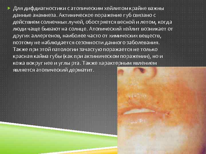  Для дифдиагностики с атопическим хейлитом крайне важны данные анамнеза. Актиническое поражение губ связано