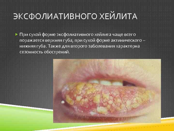 ЭКСФОЛИАТИВНОГО ХЕЙЛИТА При сухой форме эксфолиативного хейлита чаще всего поражается верхняя губа, при сухой