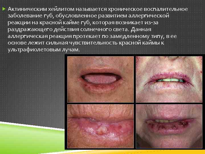  Актиническим хейлитом называется хроническое воспалительное заболевание губ, обусловленное развитием аллергической реакции на красной