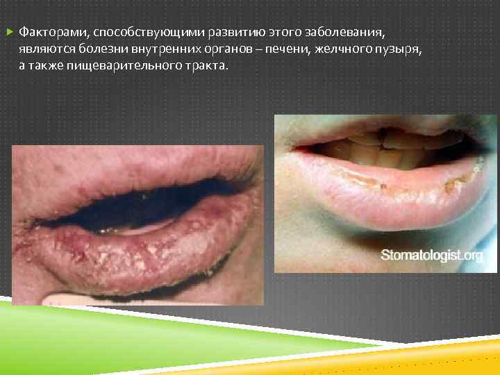  Факторами, способствующими развитию этого заболевания, являются болезни внутренних органов – печени, желчного пузыря,