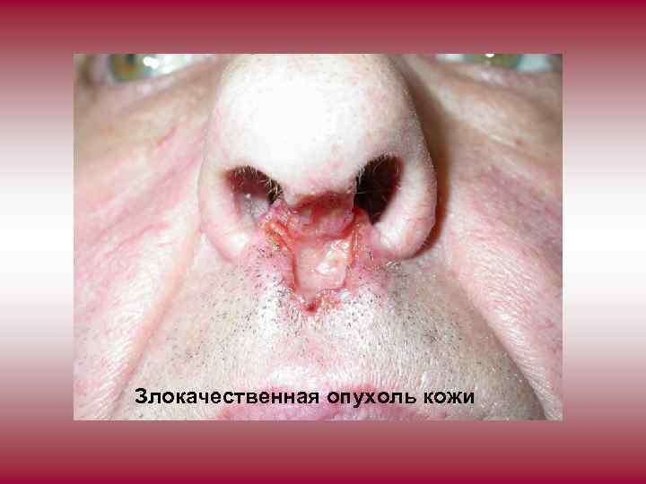 Злокачественная опухоль кожи 